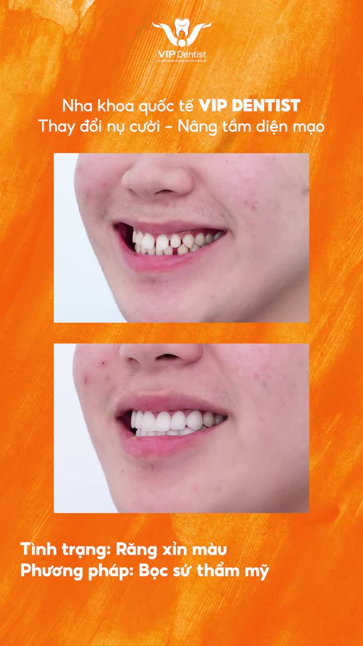 Nếu cả đời không rực rỡ thì sao? Thì đi Làm răng sứ để nụ cười rạng rỡ hơn