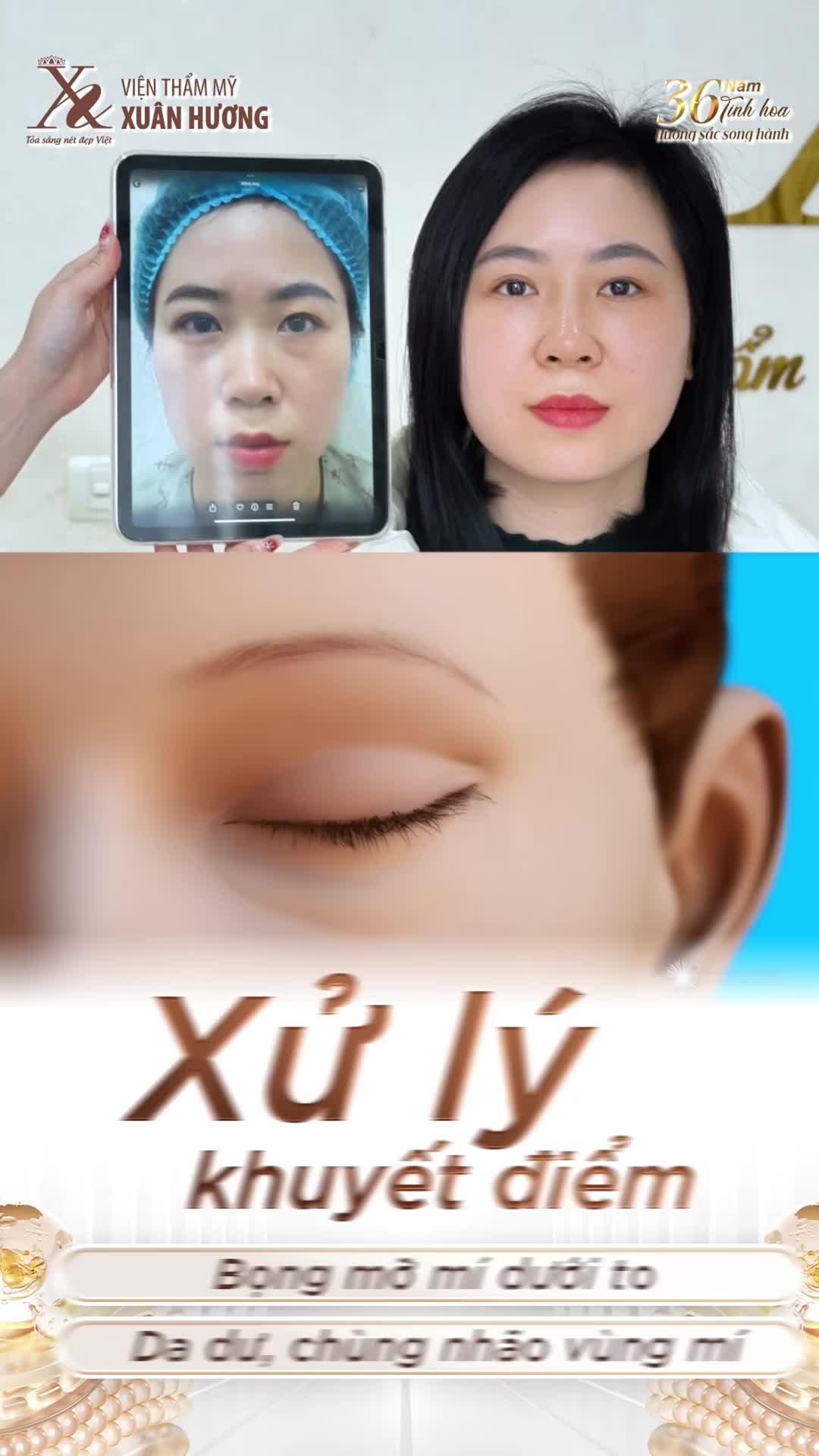 XÓA BỌNG MỠ MÍ DƯỚI CHỈ SAU 1 LẦN – TRẺ HÓA ÁNH NHÌN ĐẾN 10 TUỔI