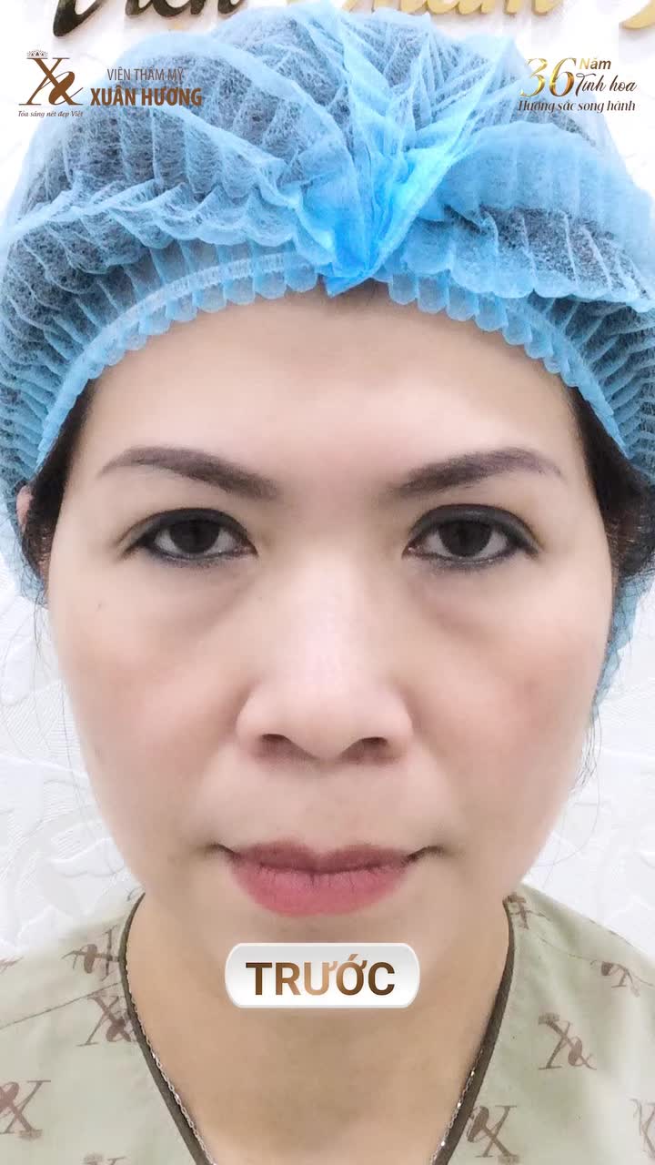HÚT SẠCH MỰC XĂM MÍ CHỈ SAU 1 LẦN – KHÔNG ĐAU, KHÔNG NGHỈ DƯỠNG!