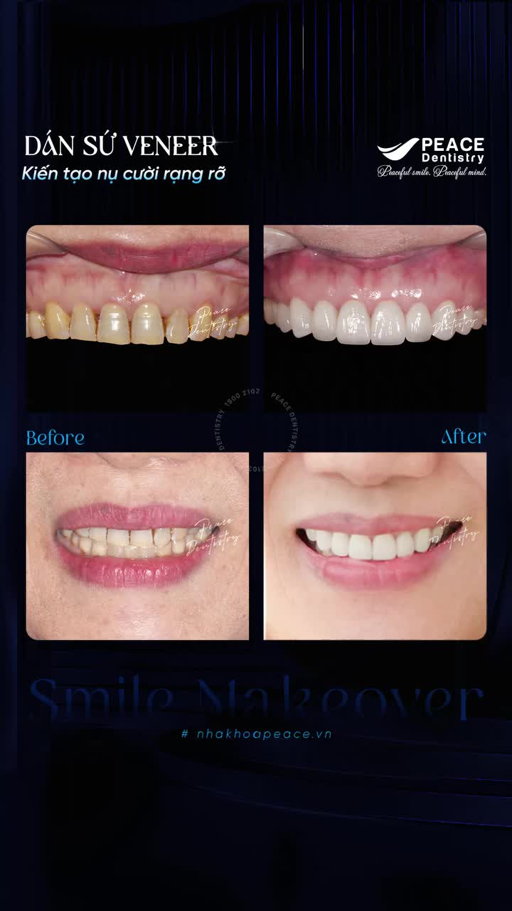 Khoảng cách từ nụ cười tự ti đến diện mạo rạng rỡ có thể chỉ cách nhau 2 buổi hẹn tại Peace Dentistry.