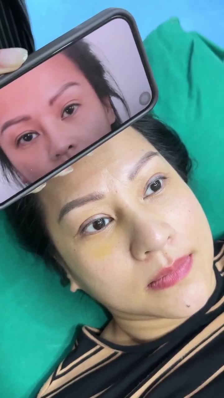 KẾT QUẢ CẮT MÍ MẮT - SỬA LẠI MÍ HỎNG KH. ALANA KIM NGUYỄN (VIỆT KIỀU MỸ)