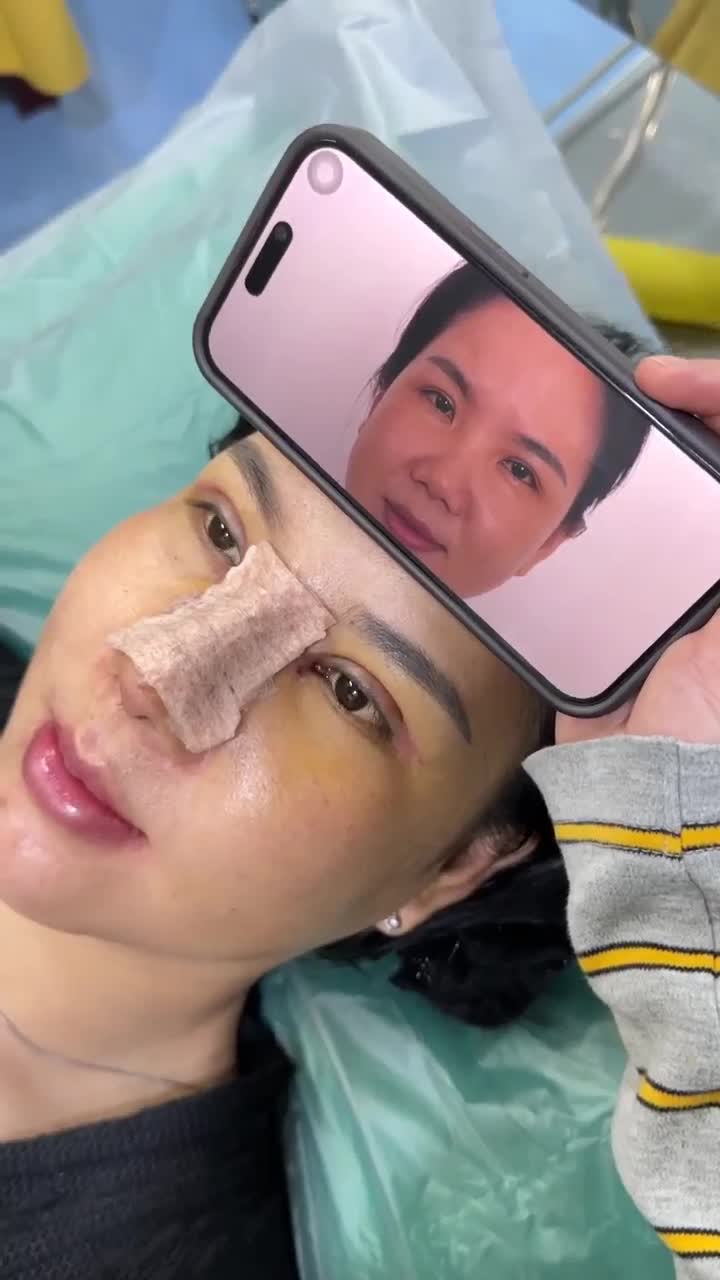 CẮT MÍ MẮT SAU 5 NGÀY SẼ NHƯ THẾ NÀO!!!