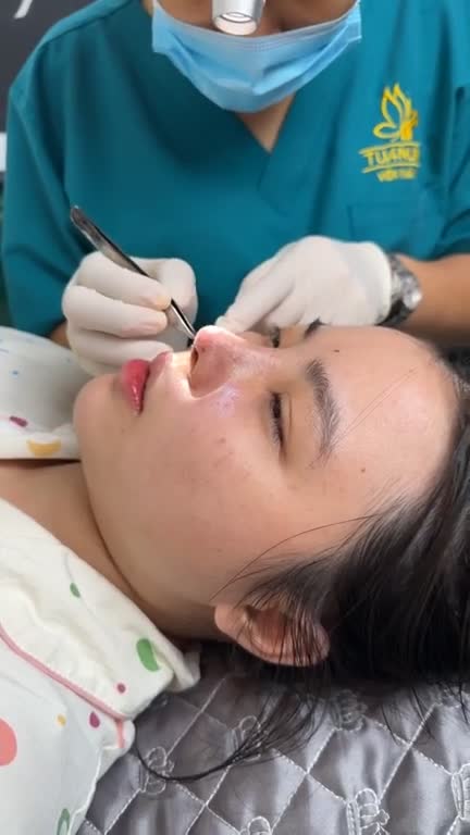 Mũi cấu trúc sau 5 ngày
