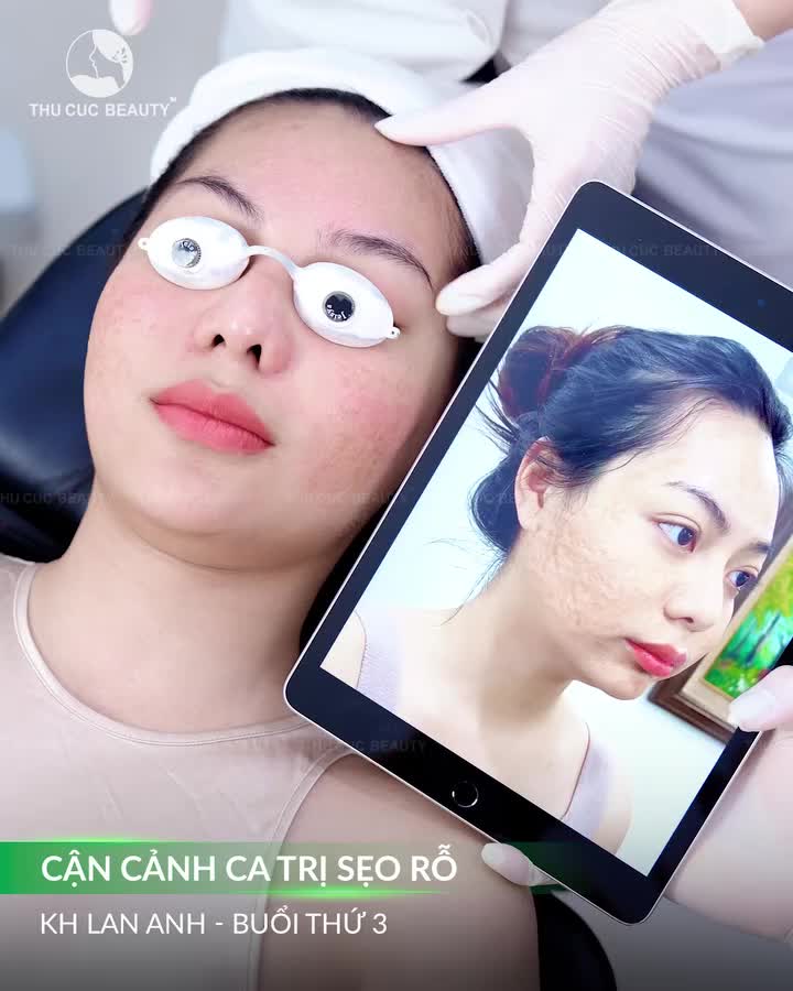 Ngại ánh sáng, ngại camera gần… chỉ vì sẹo rỗ.