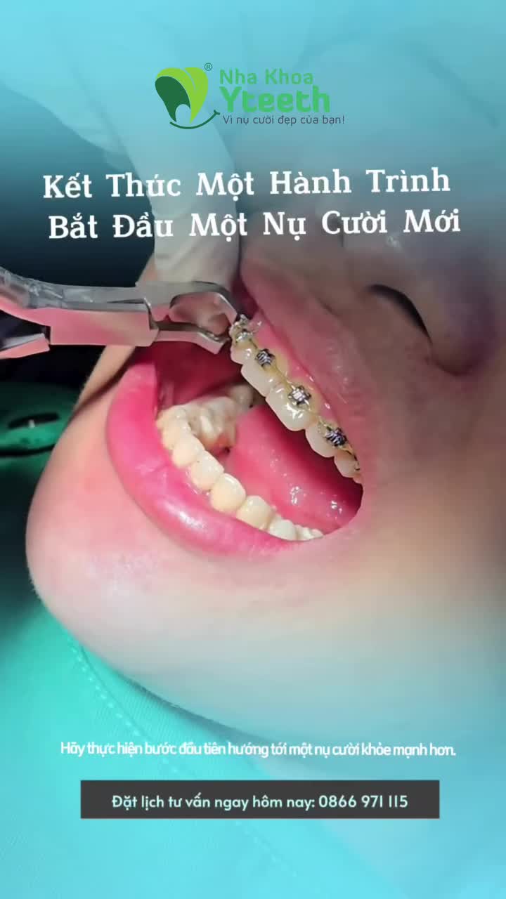 Khoảnh khắc tháo niềng – khi mọi kiên trì được đền đáp bằng một nụ cười hoàn hảo.