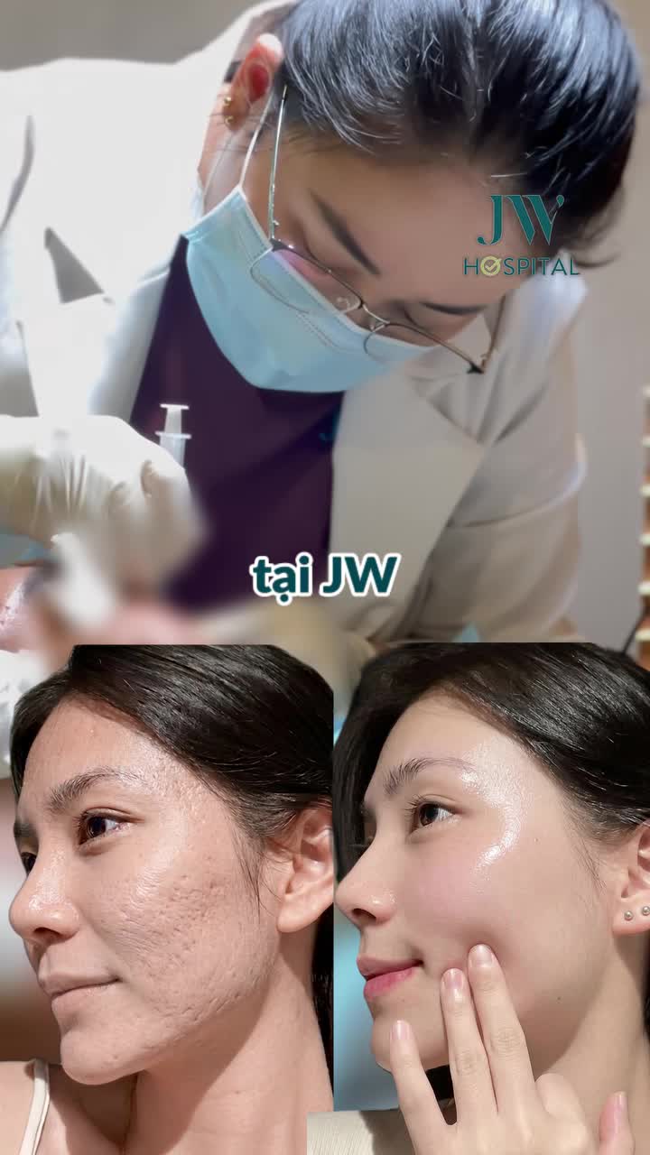 XOÁ SỔ 95% SẸO RỖ, TRẢ LẠI LÀN DA ĐẸP MỊN MÀNG SAU 1 LIỆU TRÌNH LASER FCO2 TẠI JW