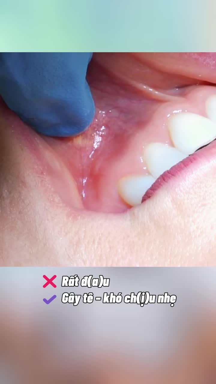 Trước khi trồng răng xem hết clip này nhé các bác