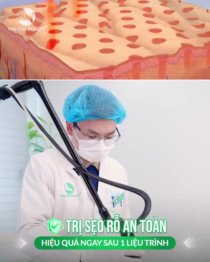 Ở đây có công nghệ trị sẹo rỗ hiệu quả tại Thu Cúc Nếu bạn đang gặp tình trạng: