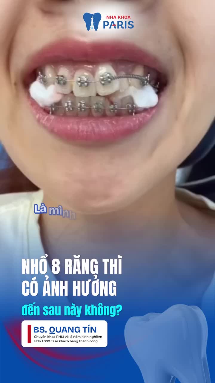 NHỔ 8 RĂNG ĐỂ NIỀNG - CÓ ĐÁNG SỢ NHƯ BẠN NGHĨ?