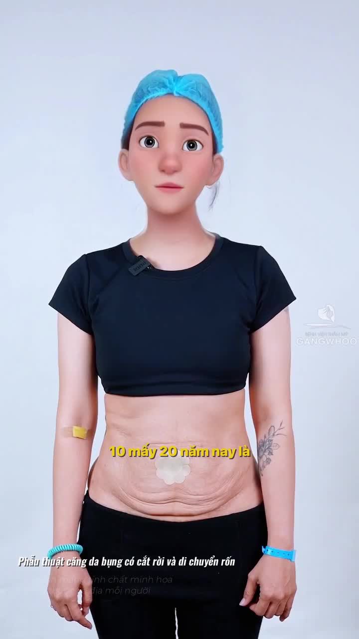 Sau 3 tháng căng da bụng tại Gangwhoo