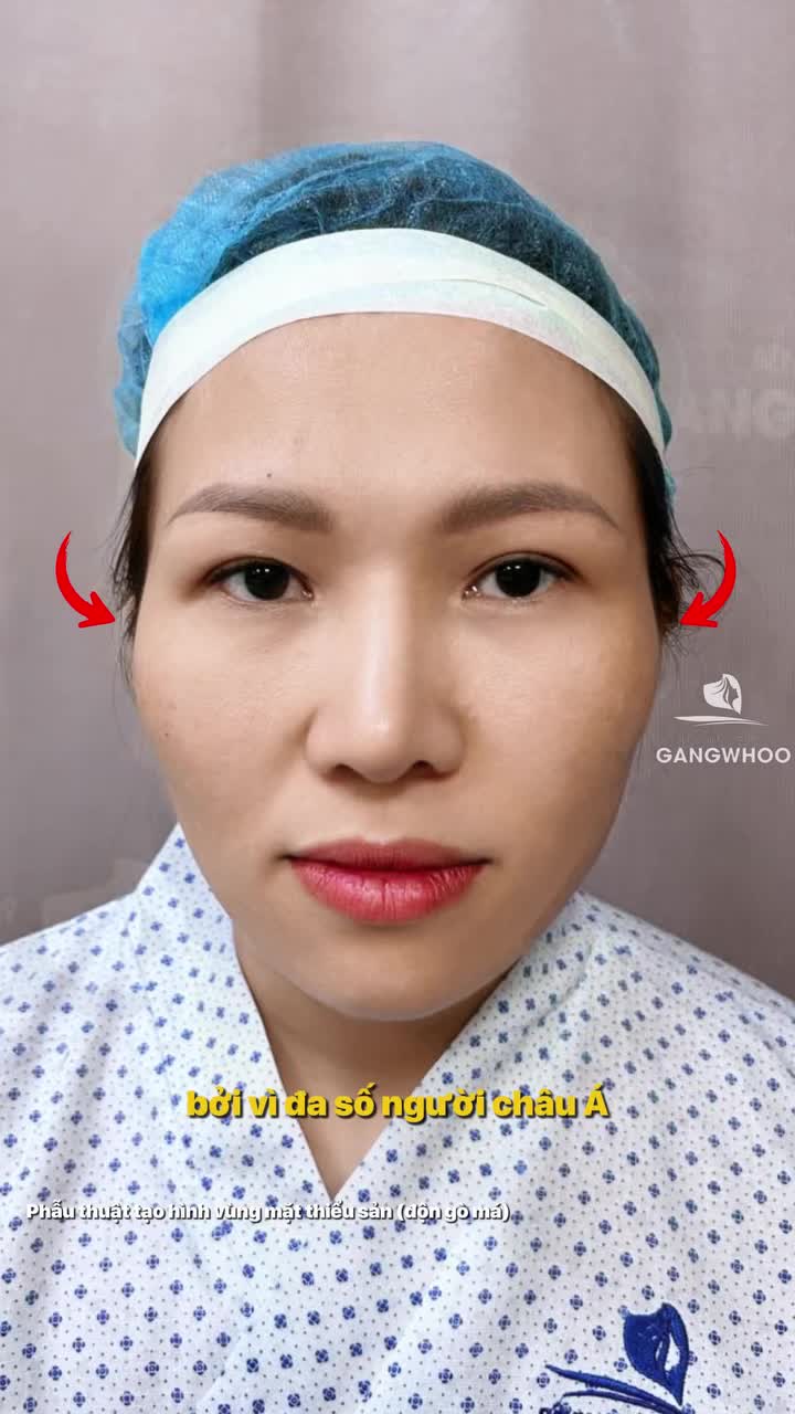 Bạn nghĩ gò má thấp là đặc điểm không thể thay đổi?