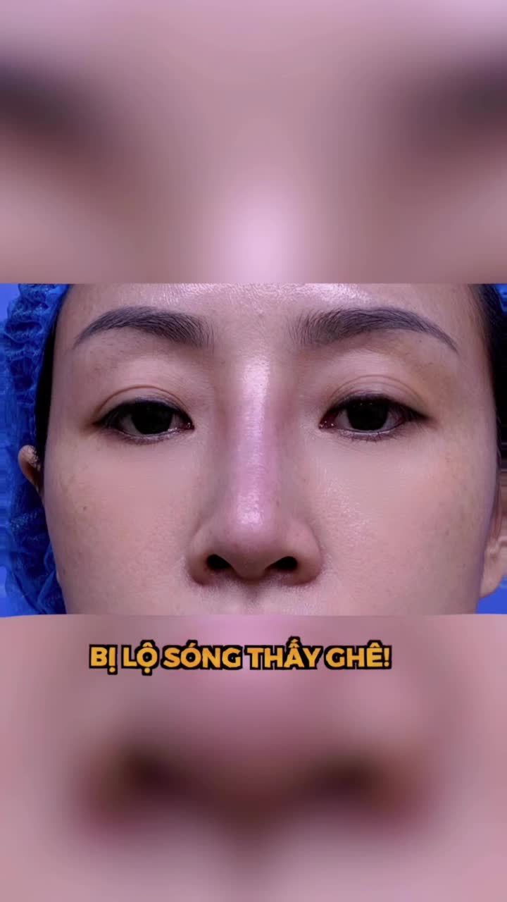 NÂNG MŨI CÓ CHẮC CHẮN BỊ LỘ SÓNG?