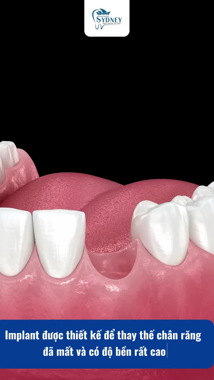 Răng Implant có sử dụng được vĩnh viễn không?