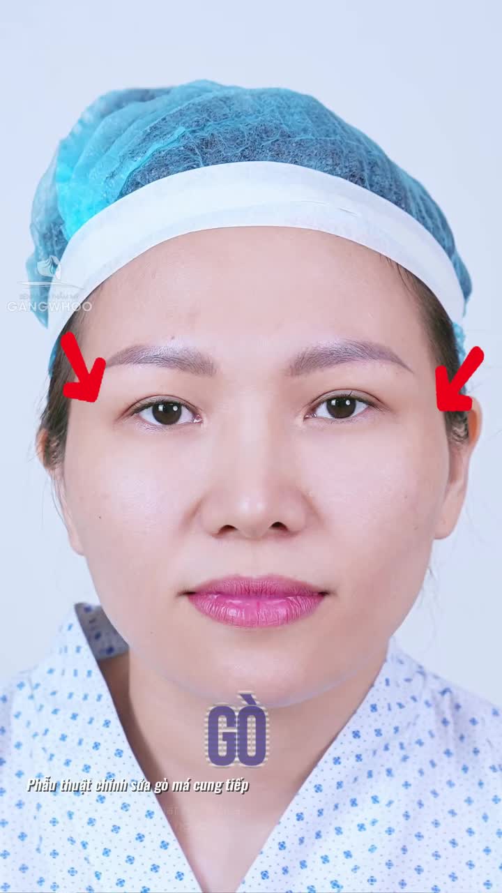 Trạng thái hiện tại của khách hàng sau ca đại phẫu HẠ GÒ MÁ nội soi 4K. Tình trạng sưng bầm không đáng kể, chị khách hoàn toàn thoải mái trong suốt quá trình nghỉ dưỡng nhẹ nhàng tại nhà.