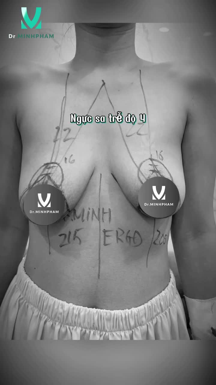 NGỰC SA TRỄ ĐỘ 4