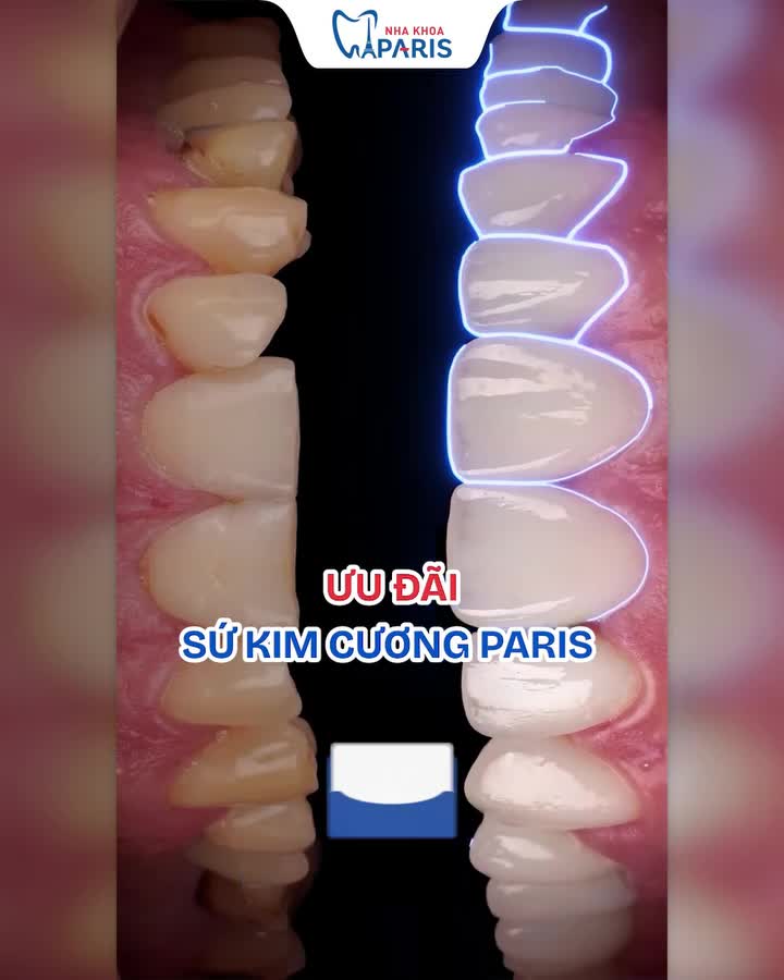 RĂNG SỨ GIẢM ĐẬM SÂU NHẤT HÈ 2026