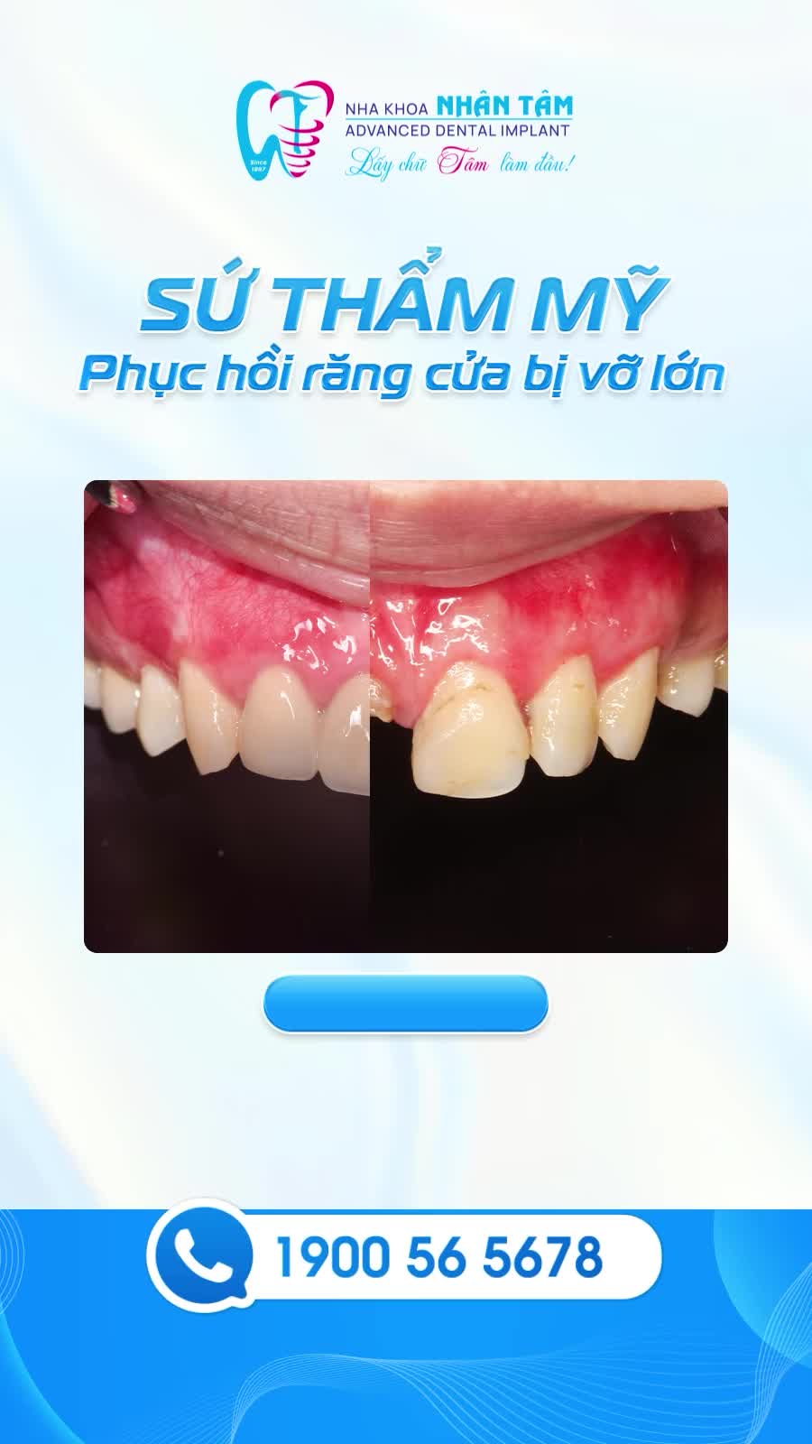 SỨ THẨM MỸ - PHỤC HỒI RĂNG CỬA BỊ VỠ LỚN