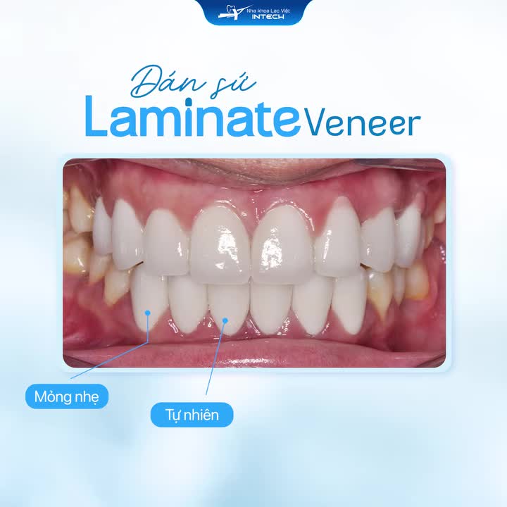 DÁN SỨ VENEER - “CỨU TINH” CHO NỤ CƯỜI CHƯA HOÀN HẢO!