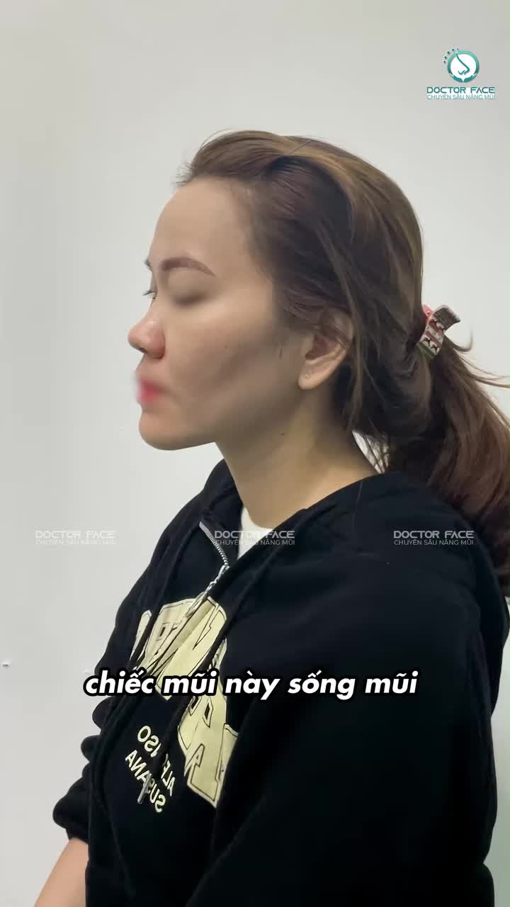 Nhiều bạn hỏi sao bs không làm mũi cao Tây