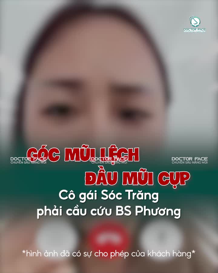 Đã từng nâng m.ũi nhưng cứ thấy có gì đó không ổn