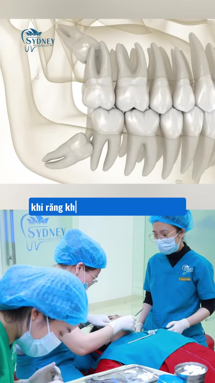 Răng khôn sưng đau có nên nhổ bỏ ngay?
