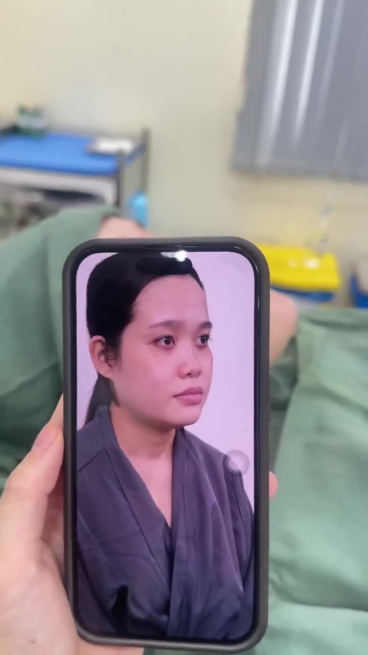 60 phút NÂNG MŨI CẤU TRÚC DR. HOẠT