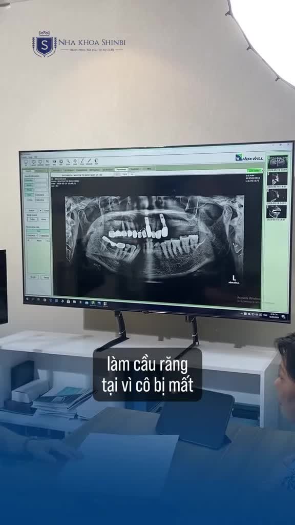 "LÀM CẦU RĂNG 2-3 BỮA LẠI GÃY, TƯỞNG SỐ MÌNH KHỔ VỚI CÁI RĂNG..."