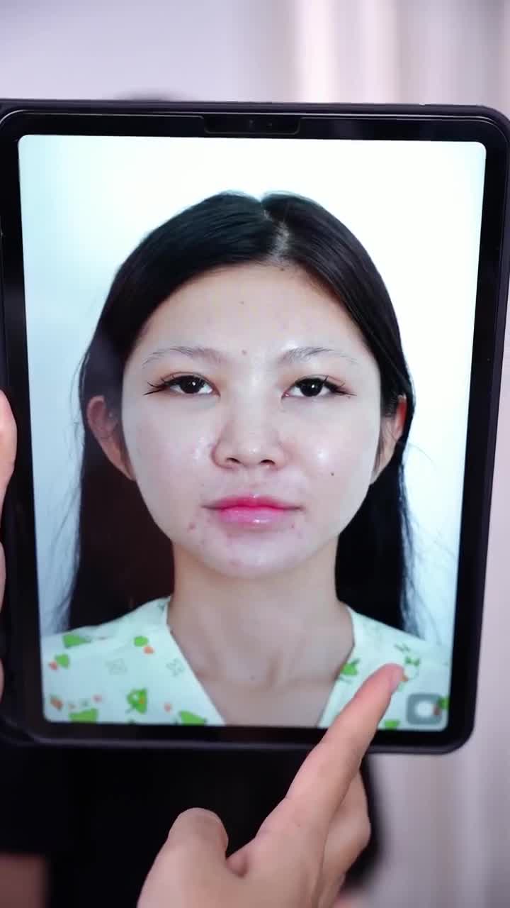 SAU 10 NGÀY XỬ LÝ FILLER + NÂNG MŨI CẤU TRÚC - SỞ HỮU MŨI ĐẸP AN TOÀN