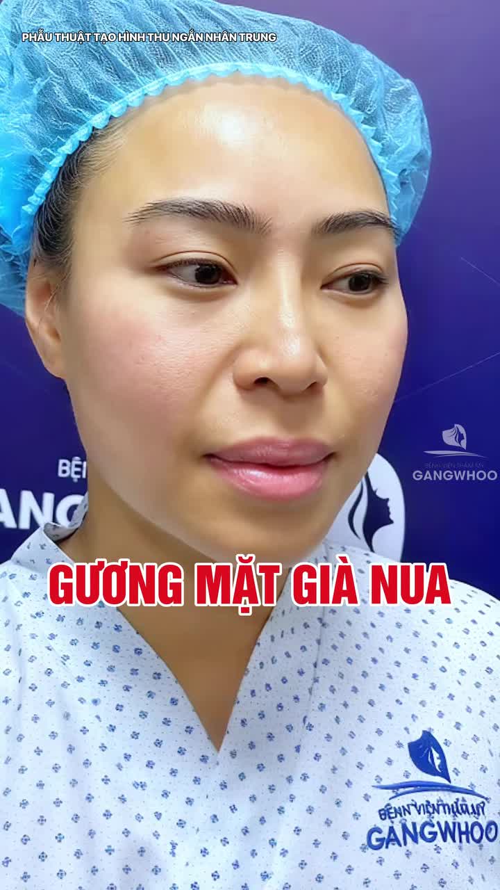 Nhân trung dài - Nguyên nhân khiến gương mặt trông già nua