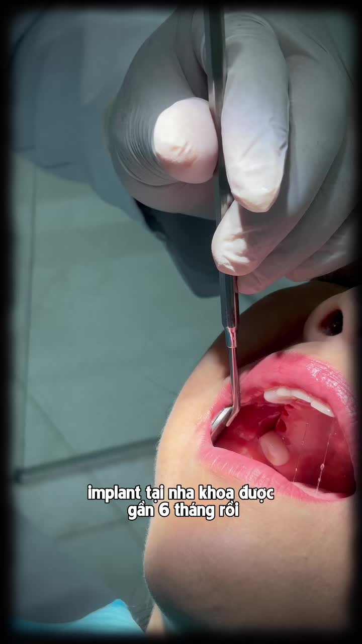 Implant xong phải đợi bao lâu? Khi nào có răng để thoải mái ăn nhai, cười tươi ? Ở clip này cùng Ths.Bs Trần Văn Vui đi qua quy trình làm từ khi cắm Implant đến khi có răng cho mình nhé