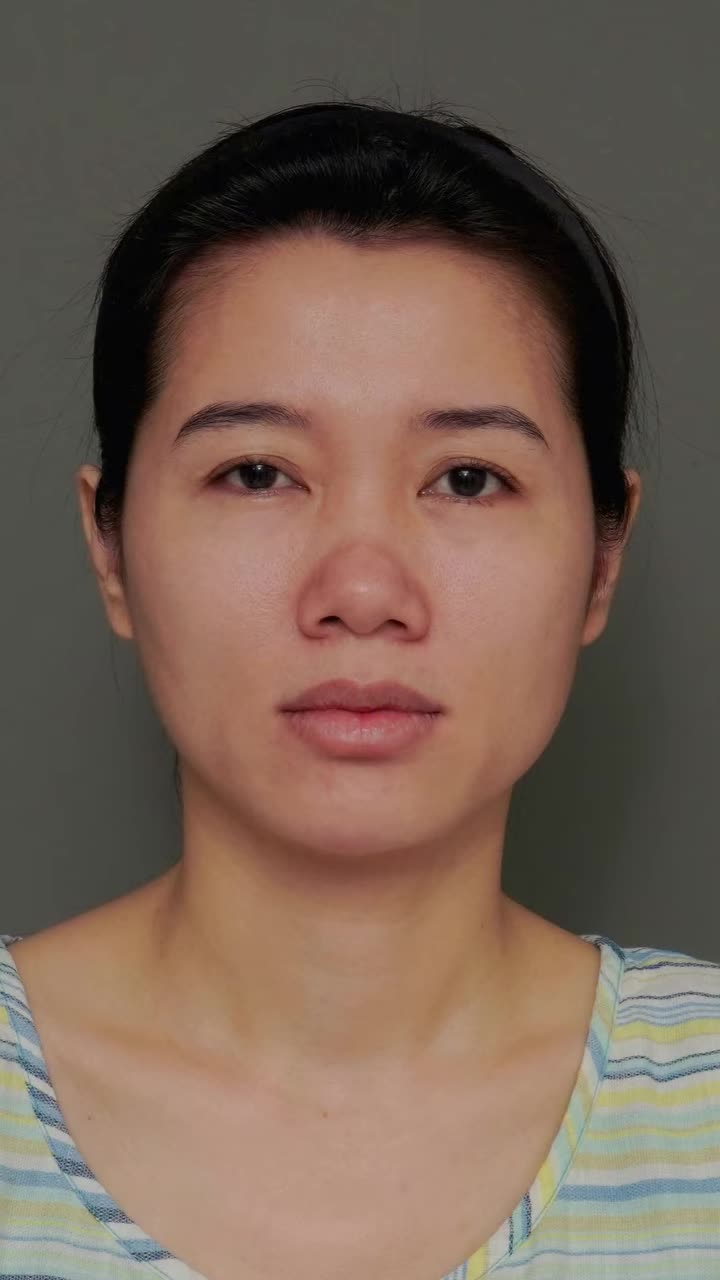 CẢI THIỆN MŨI GỒ, DÁNG MŨI ĐẸP TỰ NHIÊN, HÀI HÒA SAU KHI NÂNG MŨI TINY POINT