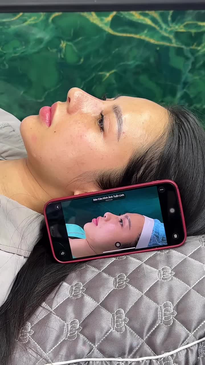 Mũi cấu trúc đục xương sau 10 ngày