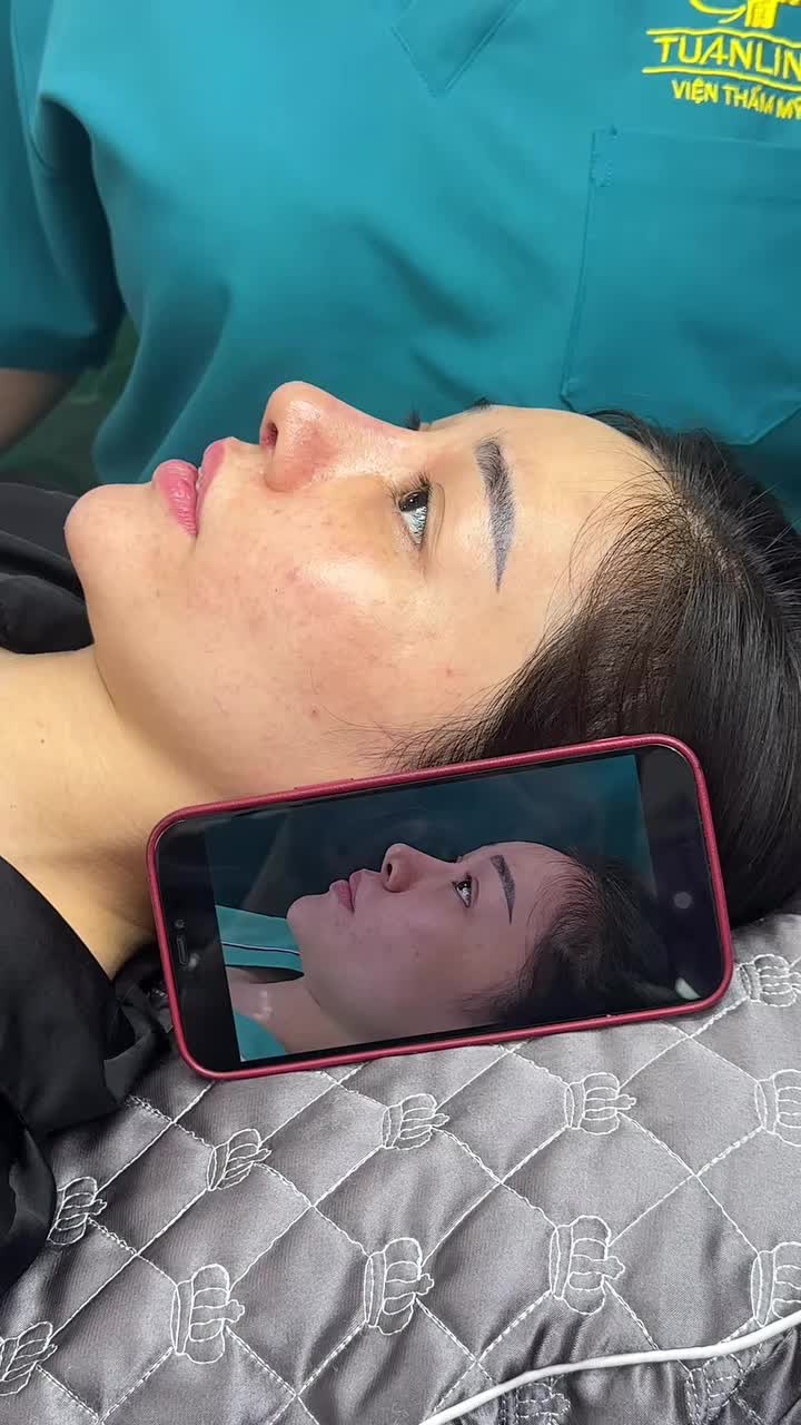 Mũi cấu trúc sửa lại surgi sau 19 ngày