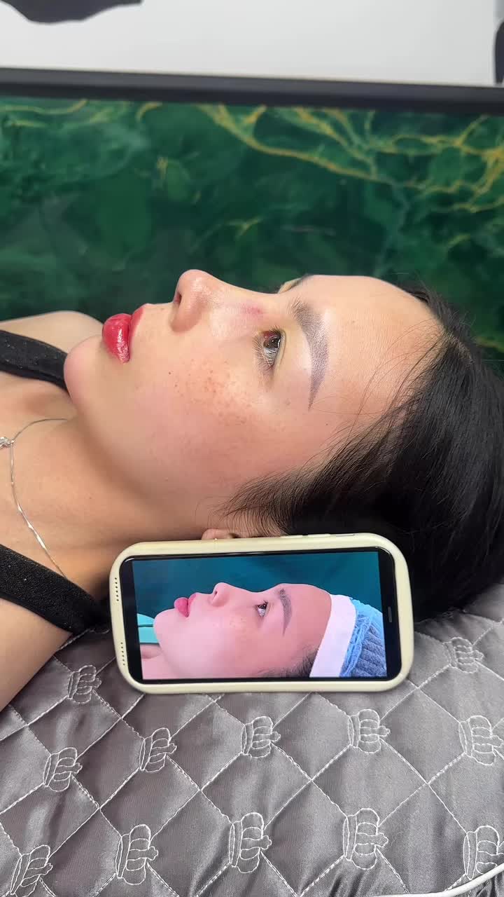 Mũi cấu trúc sau 10 ngày