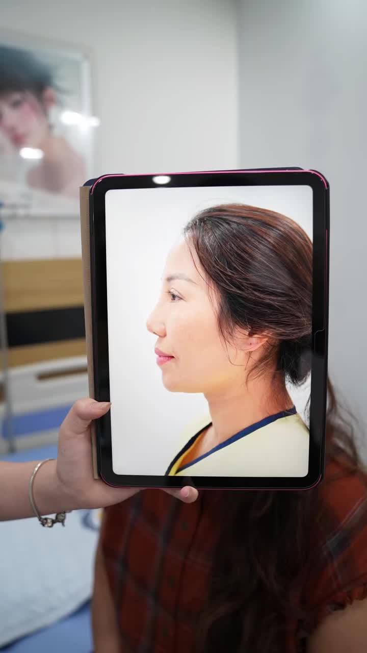" Mũi ổn định hơn chị sẽ xuống sửa mí tiếp" câu nói của cô giáo Hợp ở Sơn La sau khi tái khám dáng mũi sửa 10 ngày tuổi cho hay vì quá ưng kết quả và tay nghề Ekip Dr Vũ Quang