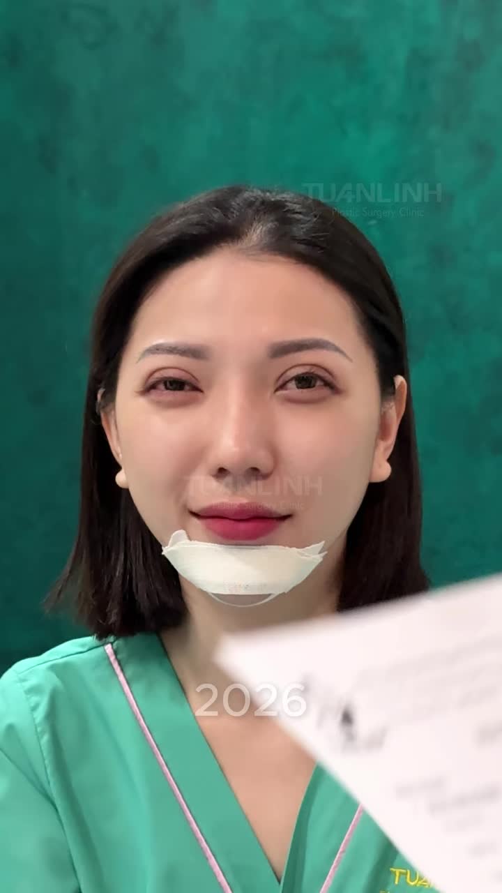 NÂNG MŨI + ĐỘN CẰM SỬA LẠI – MÀN "LỘT XÁC" ĐẸP XUẤT SẮC!!