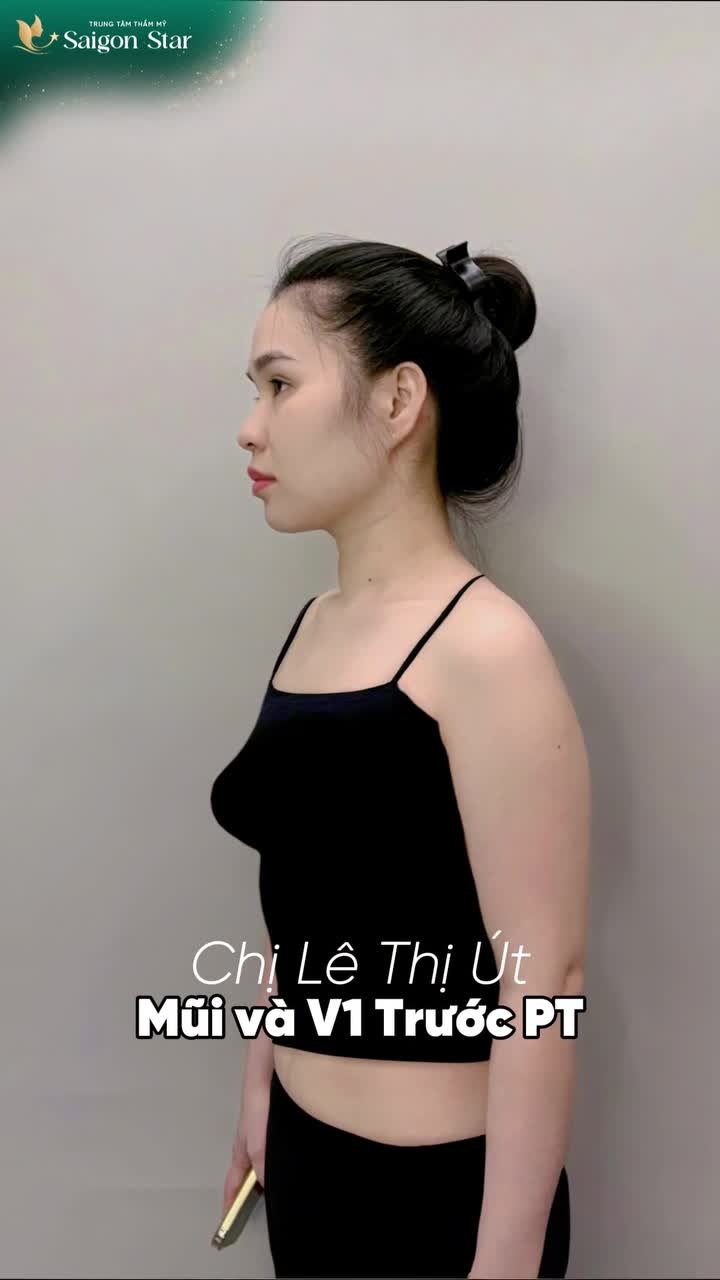 QUYẾT ĐỊNH NÂNG MŨI + NÂNG VÒNG 1 KHÁCH HÀNG SAIGON STAR TỰ TIN HƠN NGOÀI MONG ĐỢI!!