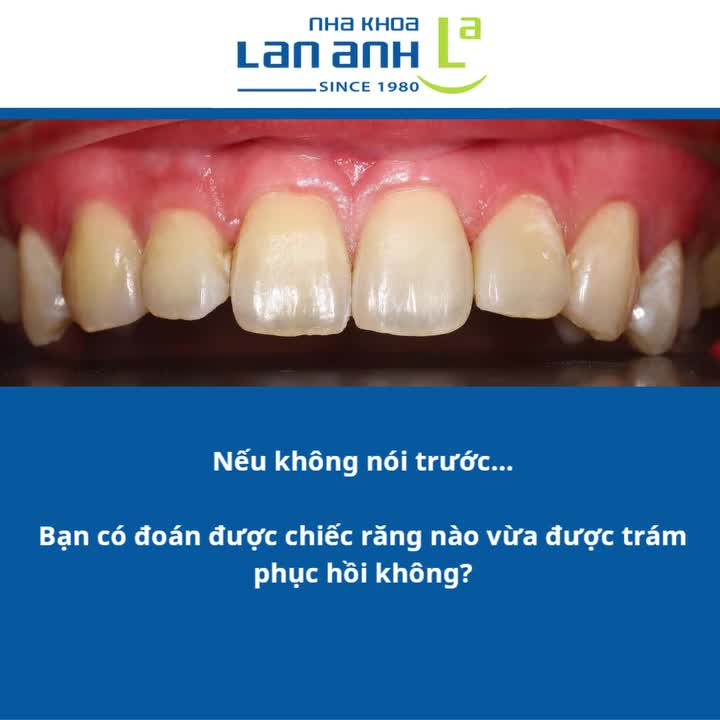 Trám răng mẻ góc đẹp đến mức... Không nói, không ai biết!