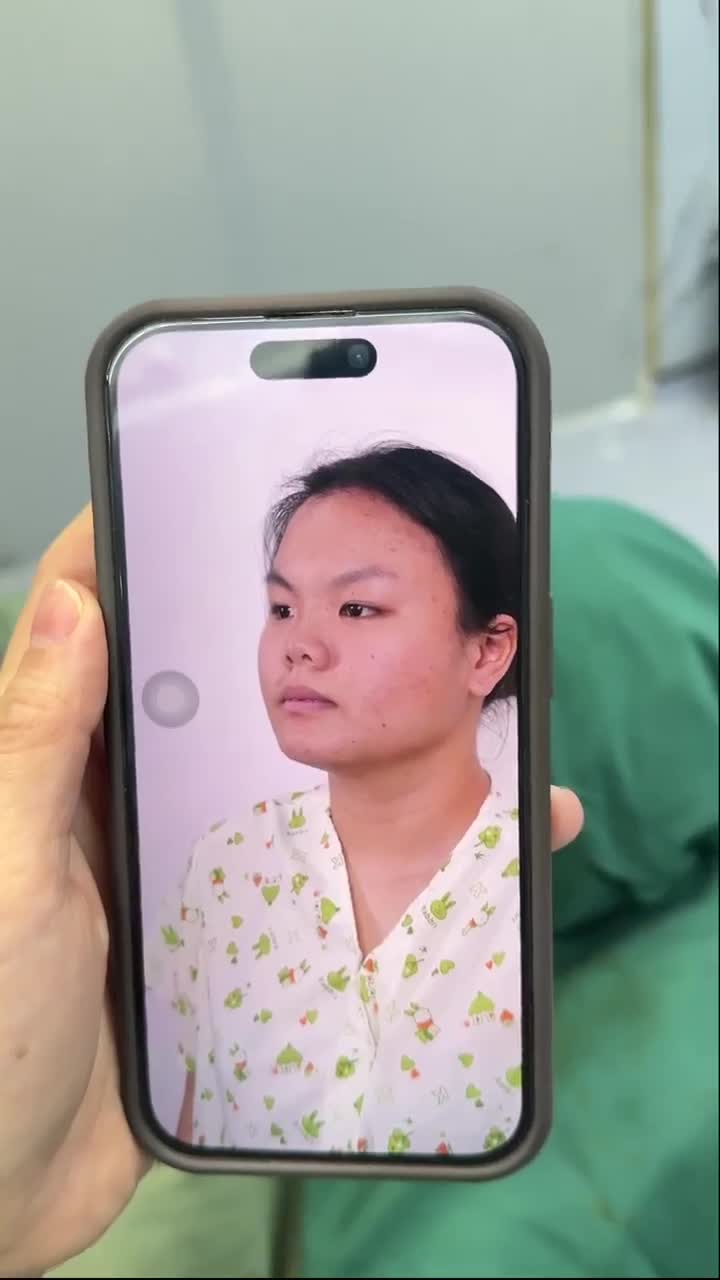 TRẢ KẾT QUẢ NÂNG MŨI NGAY SAU PHẪU THUẬT