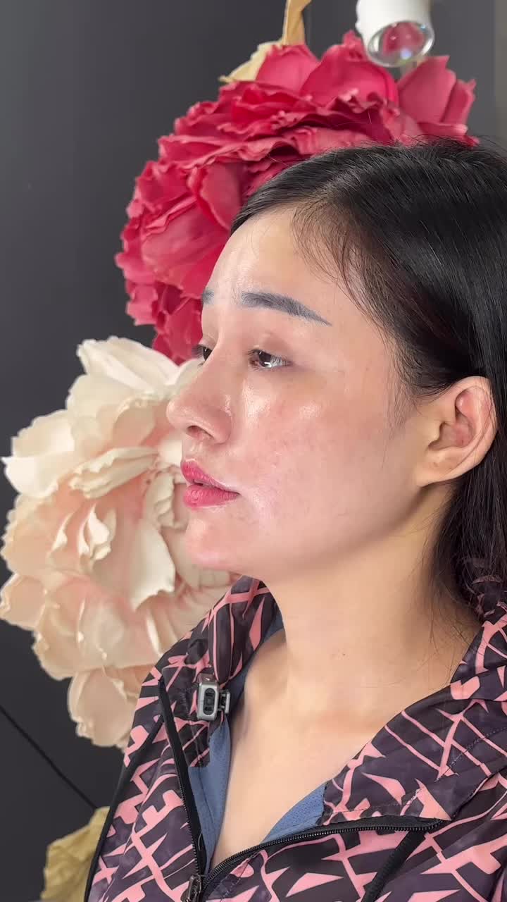 Mũi cấu trúc sửa lại suủgiform sau 15 ngày