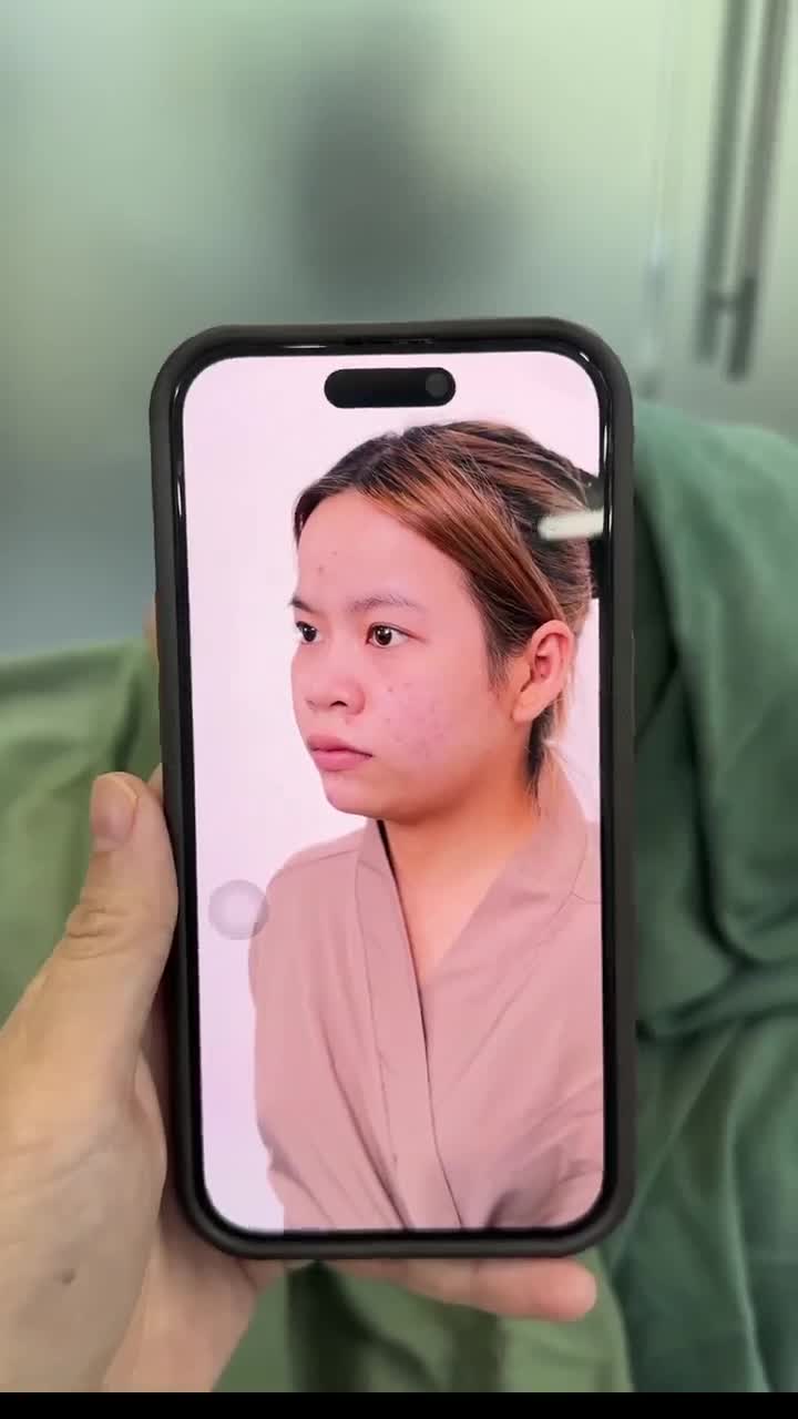 KẾT QUẢ NÂNG MŨI CẤU TRÚC  THU NỀN MŨI