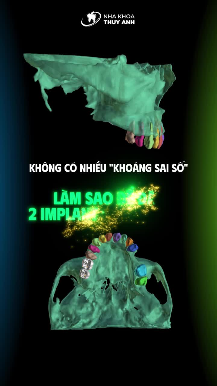 ĐIỀU GÌ XẢY RA NẾU CHỈ ĐẶT LỆCH IMPLANT VÀI MILIMET?