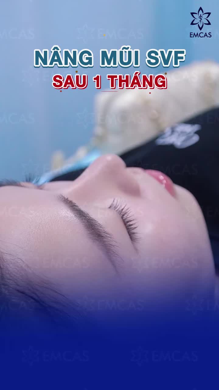 Nâng mũi SVF sau 1 tháng: form mũi ổn định, đường nét mềm mại và tự nhiên.