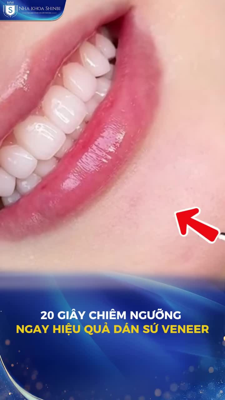 Xem thêm 84 video Mặt Dán Sứ Veneer của bác sĩ Bs nha khoa Shinbi
