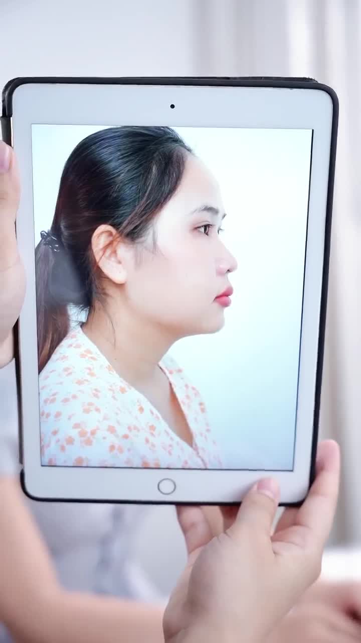 TRẢ KẾT QUẢ SAU HÀNH TRÌNH 10 NGÀY THAY ĐỔI NHAN SẮC CÙNG NÂNG MŨI CẤU TRÚC DR. HOẠT!!!