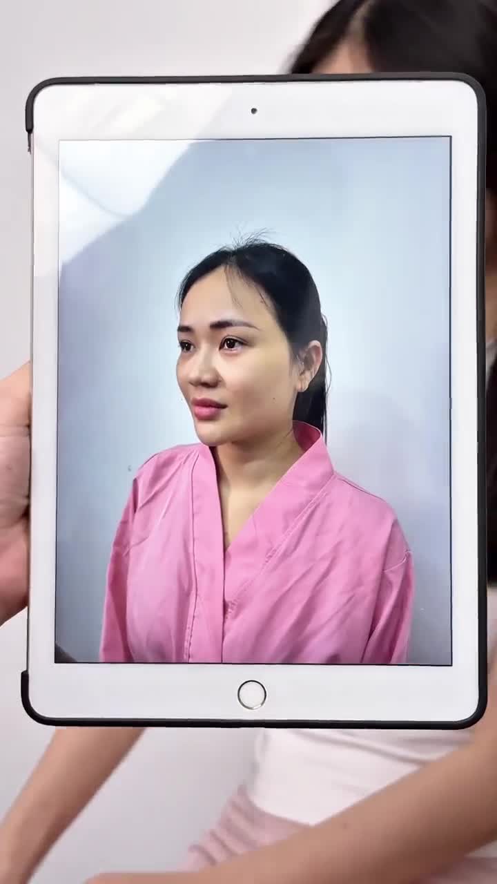KẾT QUẢ SAU 10 NGÀY NÂNG MŨI CẤU TRÚC DR. HOẠT |KH: ĐÌNH THƠM (QUẬN 4)