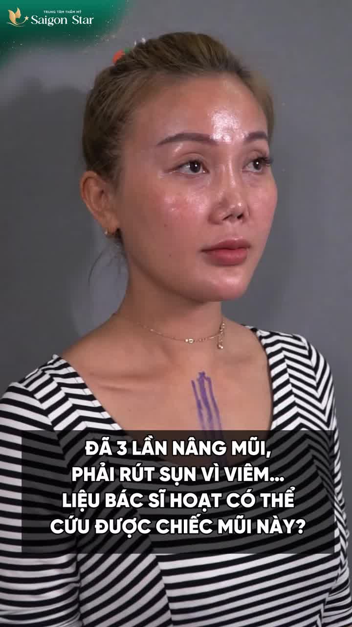ĐÃ 3 LẦN NÂNG MŨI HỎNG VÀ ĐỀU PHẢI RÚT SỤN, NGỠ LÀ HẾT