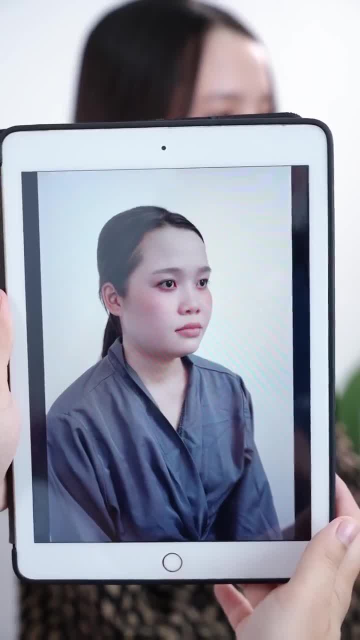 NÂNG MŨI SAU 10 SẼ NHƯ THẾ NÀO???