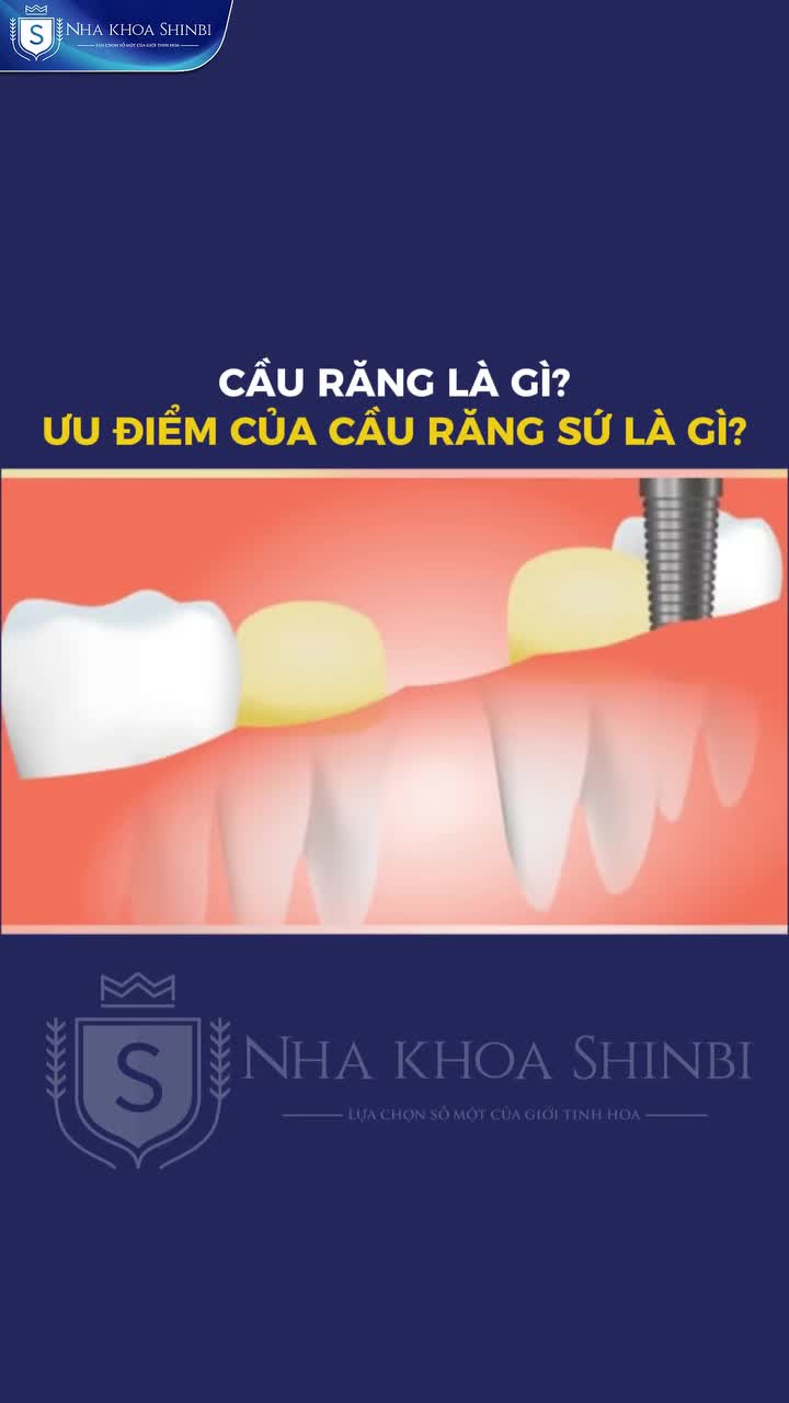Cầu răng là gì Ưu nhược điểm của cầu răng sứ