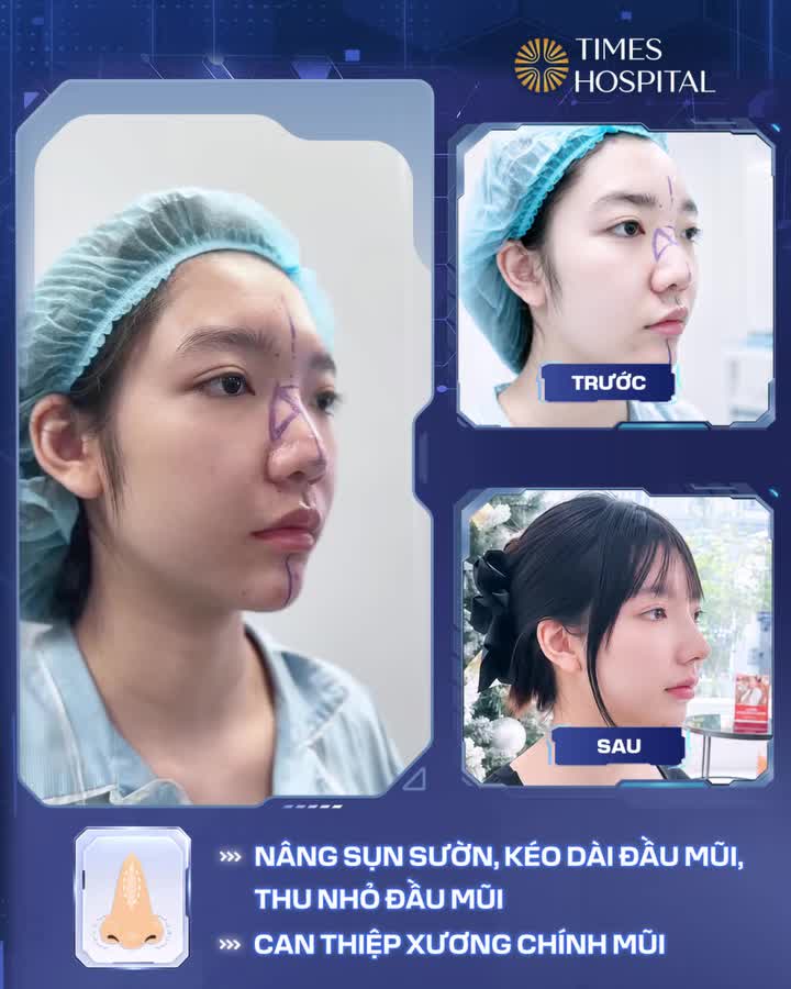 NÂNG MŨI TỰ NHIÊN – LÊN HÌNH ĐẸP KHÔNG CẦN FILTER